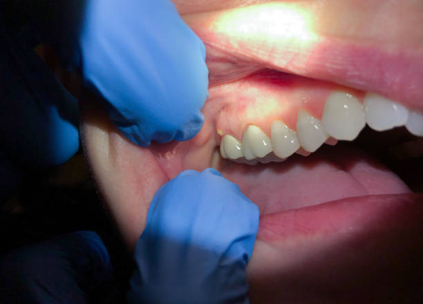 Best Broken or Cracked Tooth Emergency Dentist in Lyons, IL